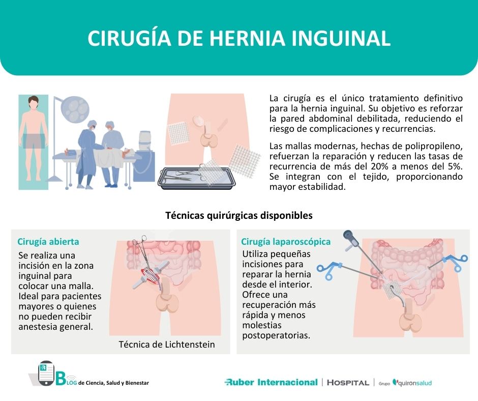 Cirugía de la Hernia inguinal: ¿Es necesario operar?